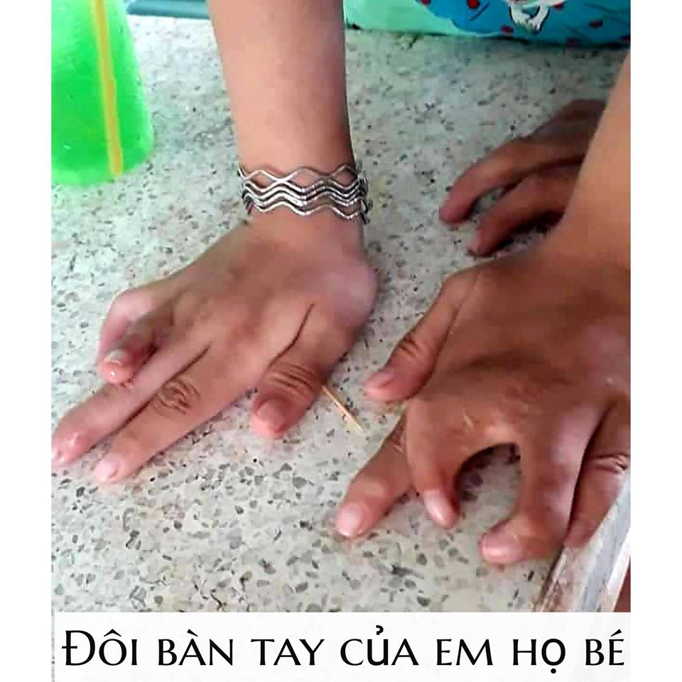 Một dòng họ ở Tiền Giang bị dị tật "càng cua" hiếm gặp