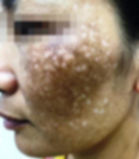 Chi h&agrave;ng trăm triệu chữa n&aacute;m m&aacute; da mặt vẫn loang lổ, sạm đen - Ảnh 1.