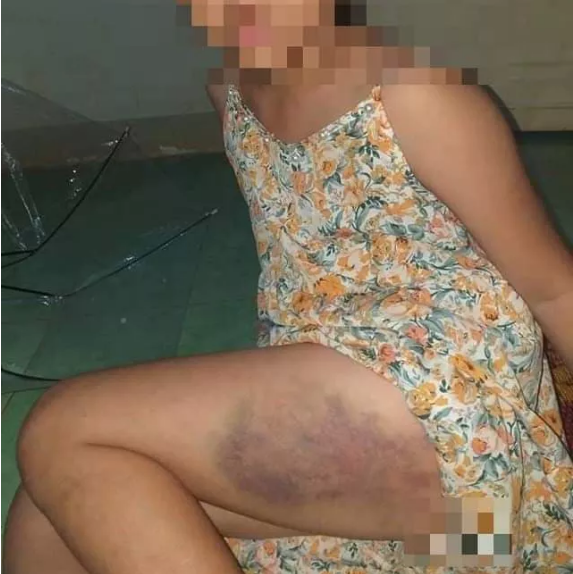 Cô giáo đánh bầm dập bé gái lớp 3 vì "làm bài sơ sài"?