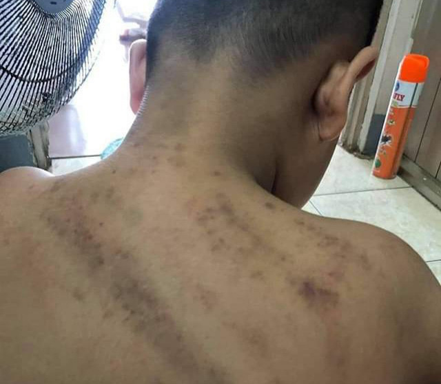Nhiều vết bầm trên lưng, cổ bé trai 8 tuổi ở Phú Quốc nghi bị đánh