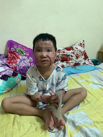 Câu chuyện cậu bé bị dì tẩm xăng đốt