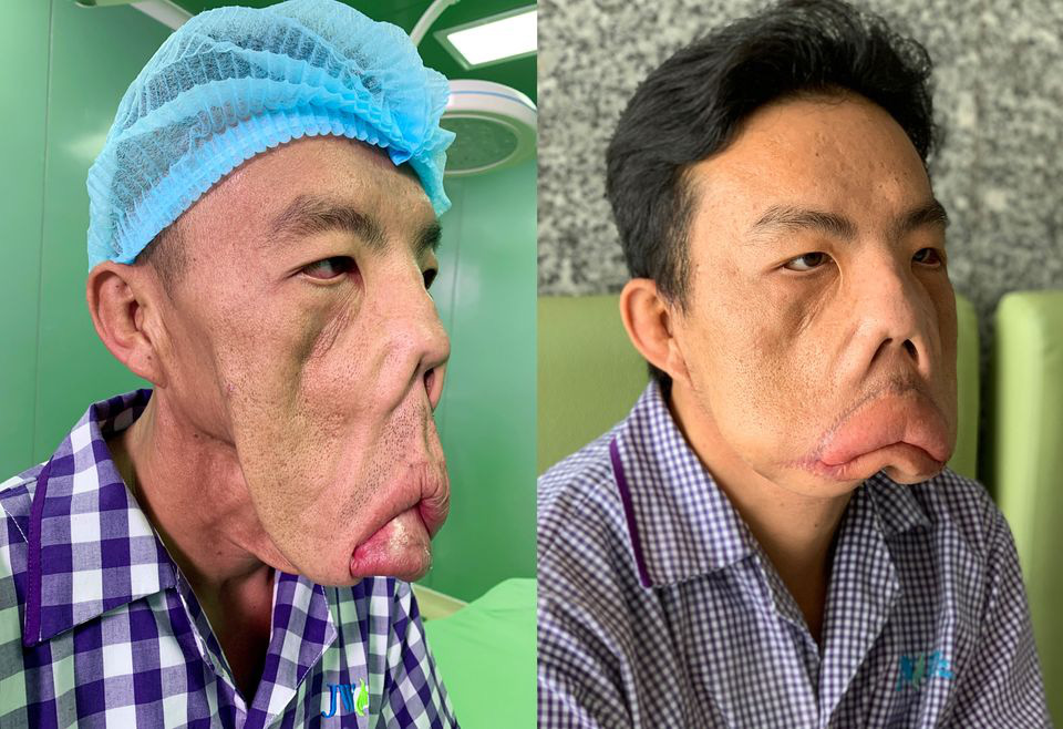 Tìm ra được "bệnh lạ" cho chàng trai "mặt quỷ"