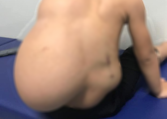 Bé 2 tuổi oằn mình cõng khối u mỡ 4 kg trên lưng