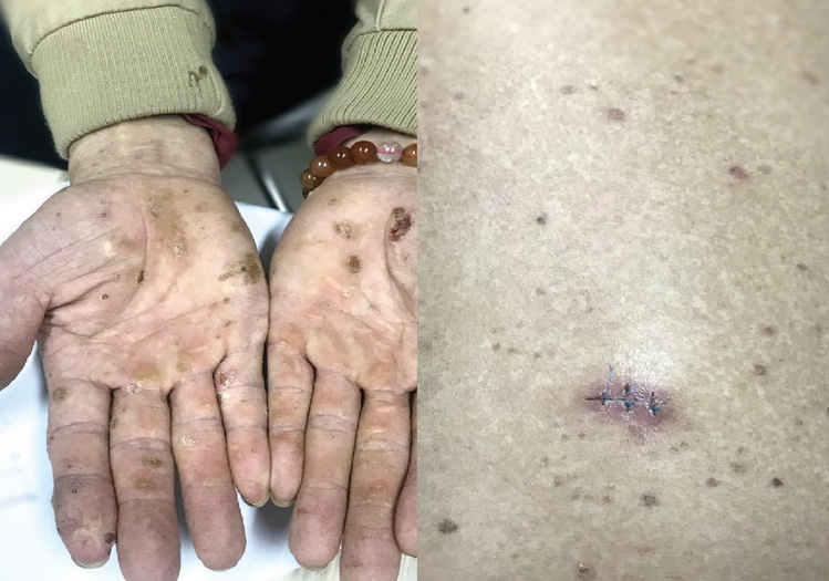 Nhiễm độc thạch tín gây ung thư da từ mỹ phẩm không rõ nguồn gốc