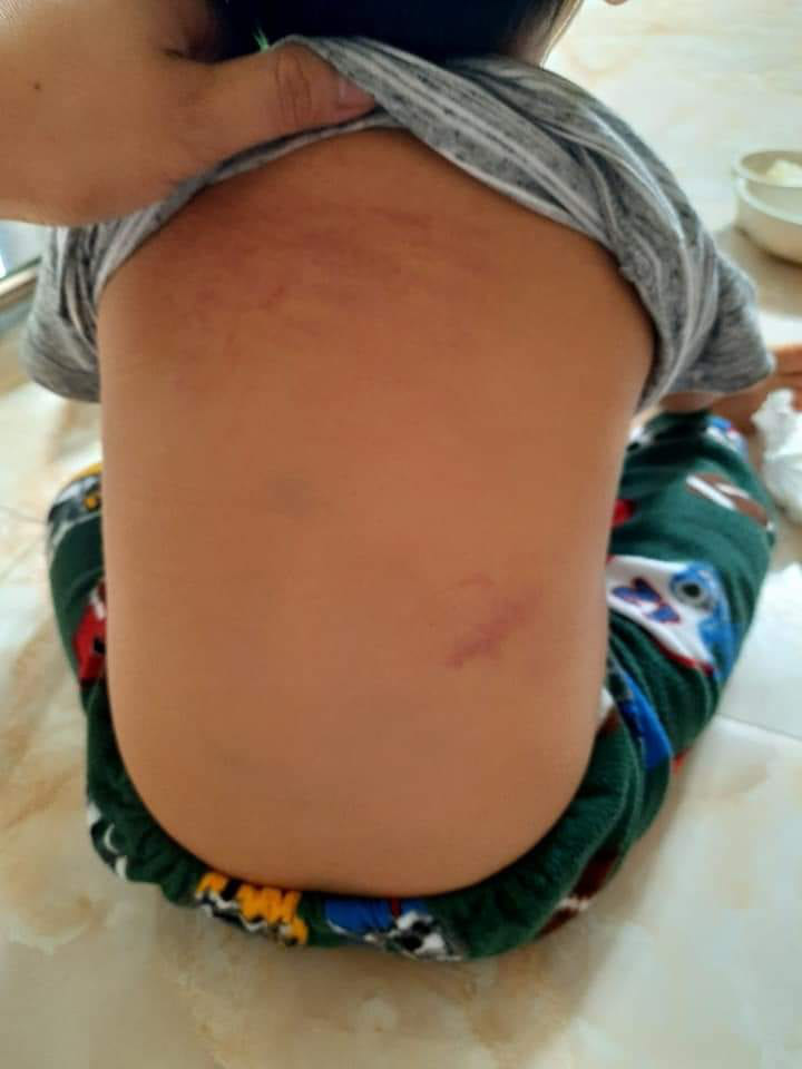 Vụ trẻ mầm non 15 tháng tuổi bị giáo viên bạo hành: Cô giáo nói dối cháu bị ngã