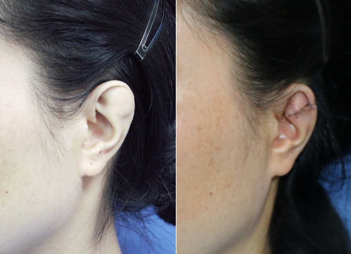 Phẫu thuật cho người phụ nữ 34 tuổi có vành tai khác thường