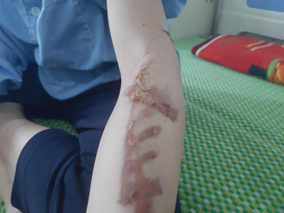 Vụ bé trai quê Quảng Ngãi bị bạo hành dã man: Đánh bằng bàn chải sắt, chày, xẻng