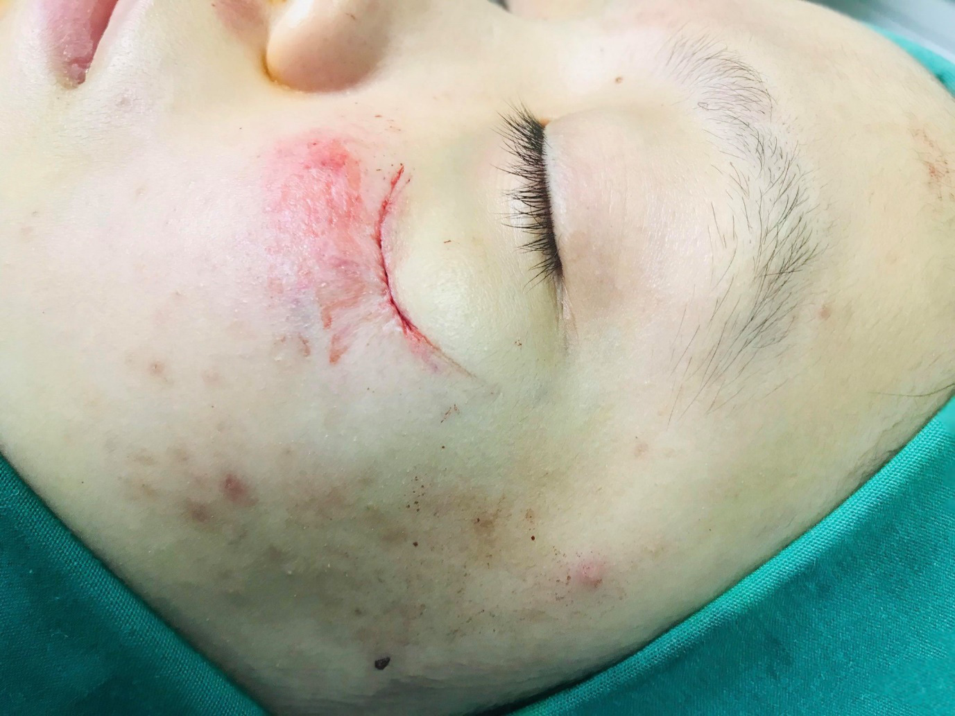 Căng não gắp từng dị vật trong vết thương do tai nạn giao thông - Ảnh 3.
