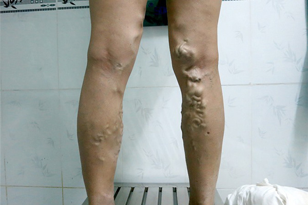 B&aacute;c sĩ điểm danh những nghề dễ mắc bệnh suy gi&atilde;n tĩnh mạch chi - Ảnh 3.