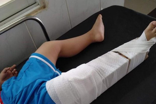 Chuẩn bị bó bột cho cháu bé 3 tuổi bị cô giáo mầm non làm gãy chân