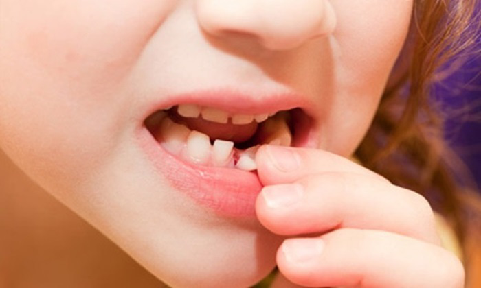Tự nhổ răng sữa ở nhà, răng vĩnh viễn dễ lệch?