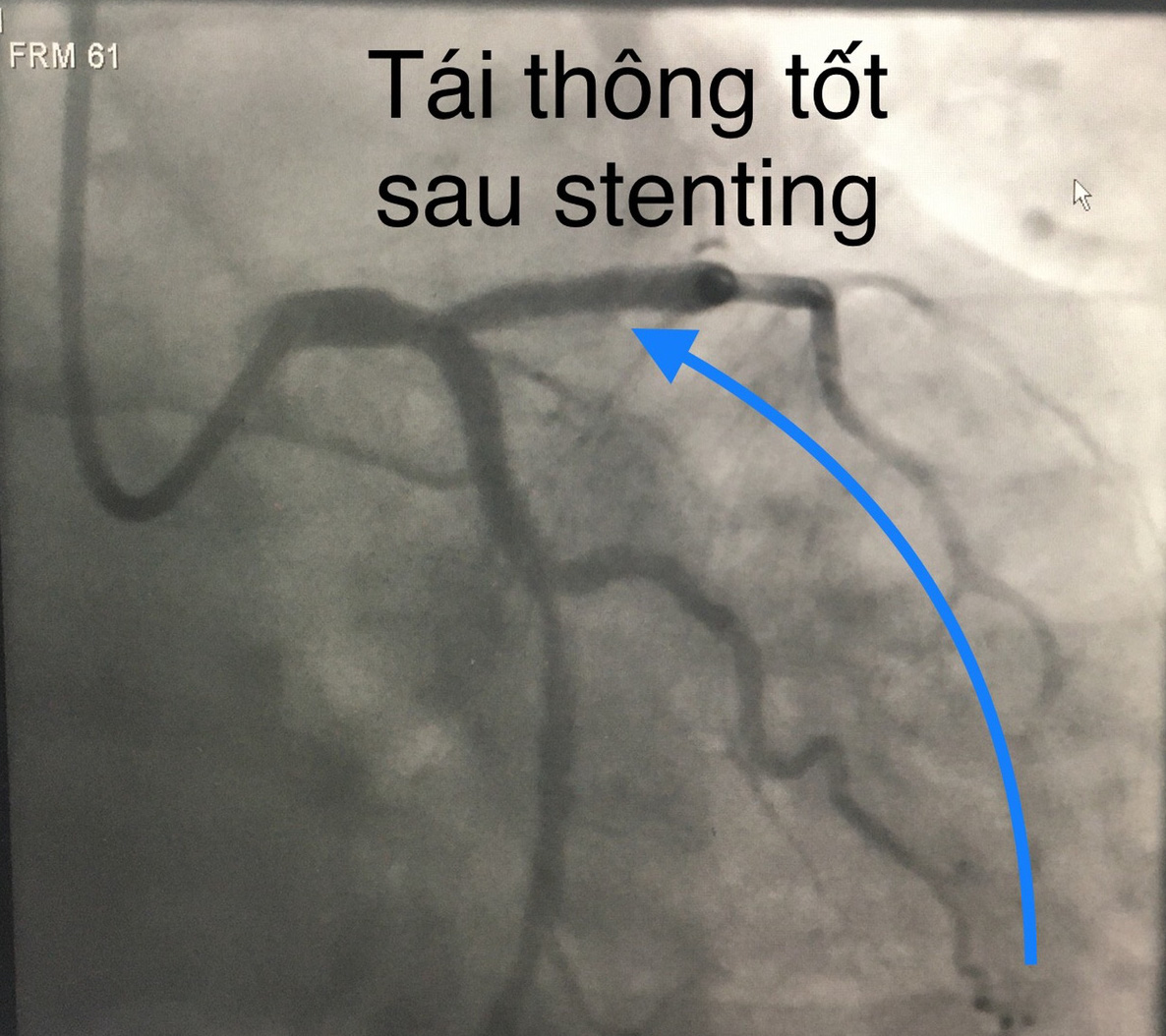Trong 2 ng&agrave;y, Bệnh viện ở miền T&acirc;y cứu sống 10 bệnh nh&acirc;n nhồi m&aacute;u cơ tim  - Ảnh 2.