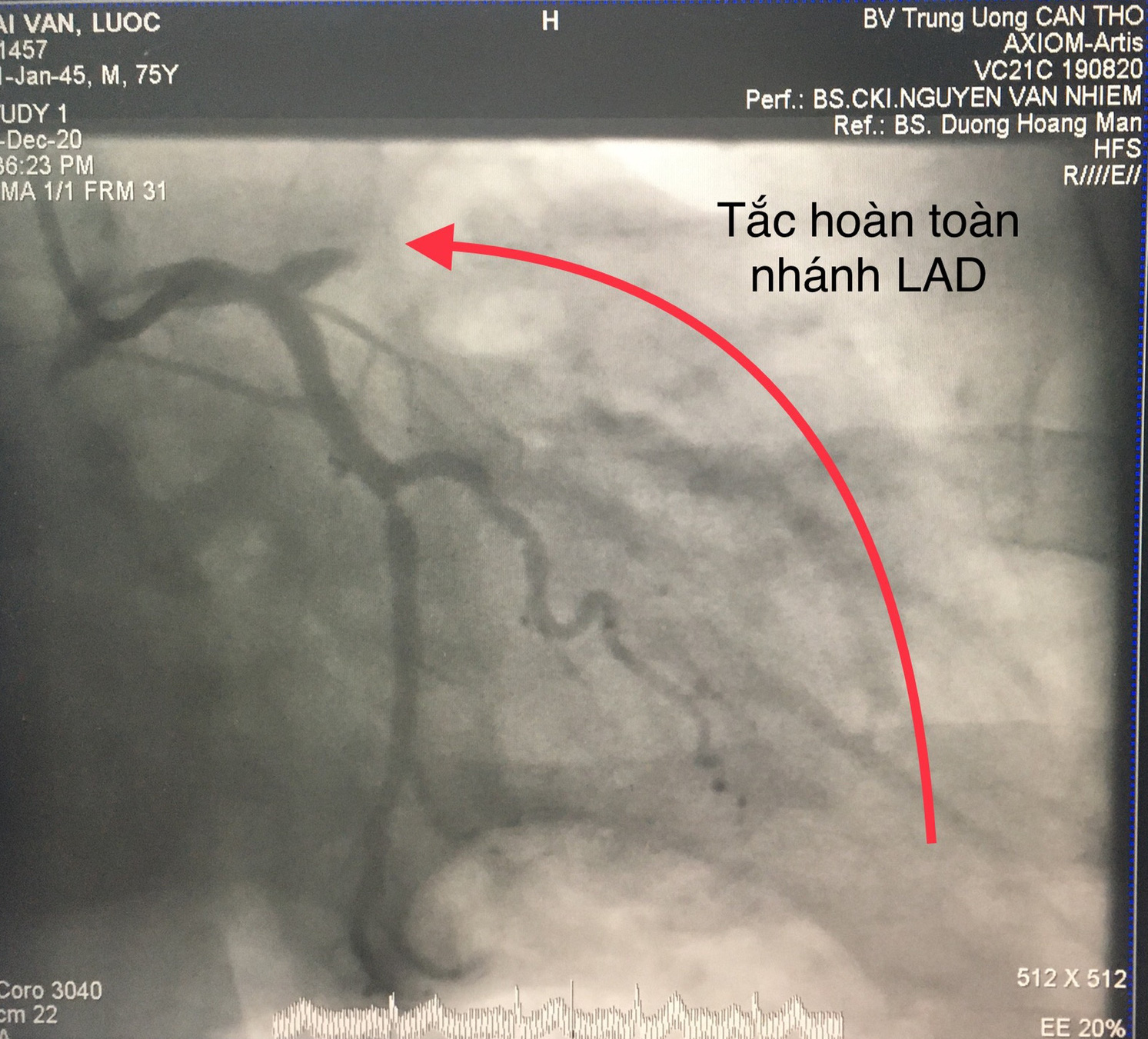 Trong 2 ng&agrave;y, Bệnh viện ở miền T&acirc;y cứu sống 10 bệnh nh&acirc;n nhồi m&aacute;u cơ tim  - Ảnh 1.