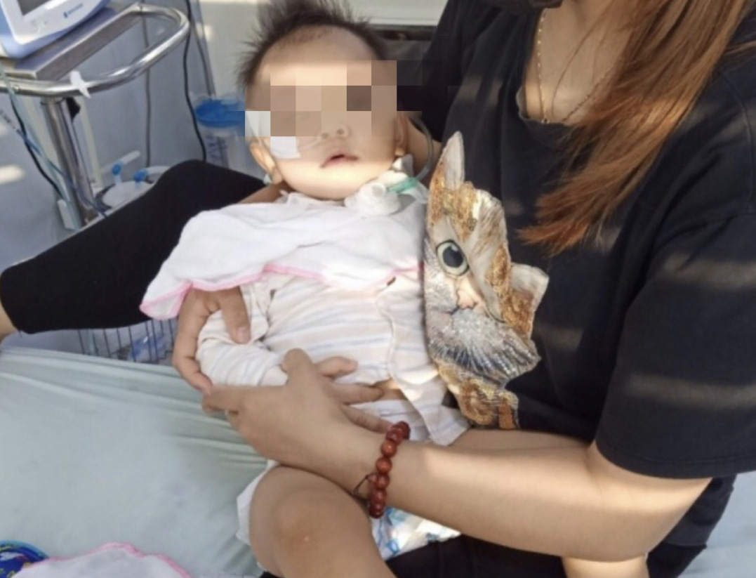 Bé gái 19 tháng tuổi liệt chi  vì bệnh tay chân miệng