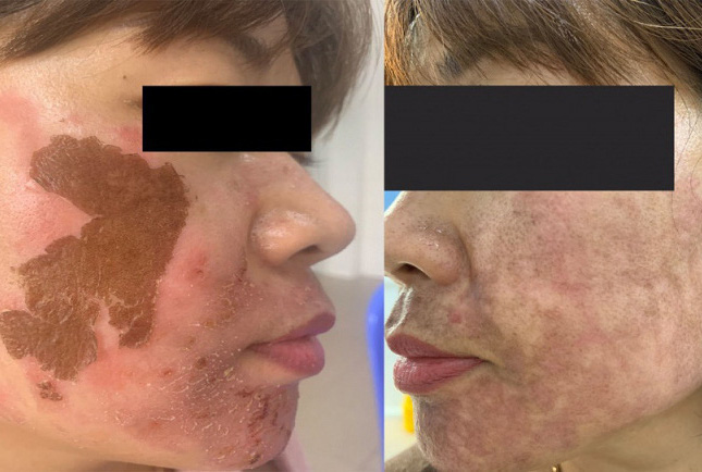Trị nám bằng cồn ở spa, người bị nữ bị biến chứng nghiêm trọng