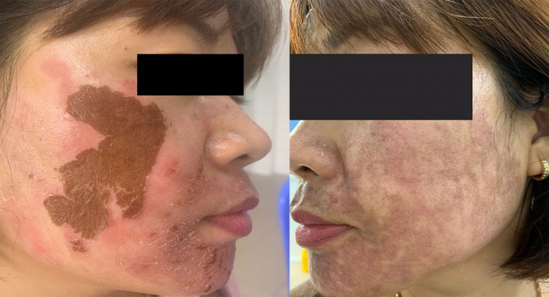 Trị nám bằng cồn ở spa, người bị nữ bị biến chứng nghiêm trọng - Ảnh 1.