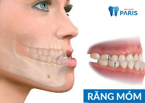Niềng răng có hết móm không?