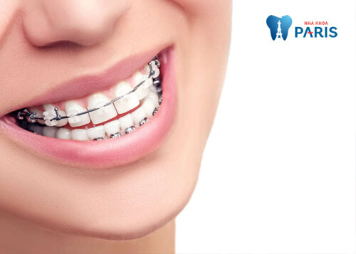 Niềng răng có hết móm không? - Ảnh 2.