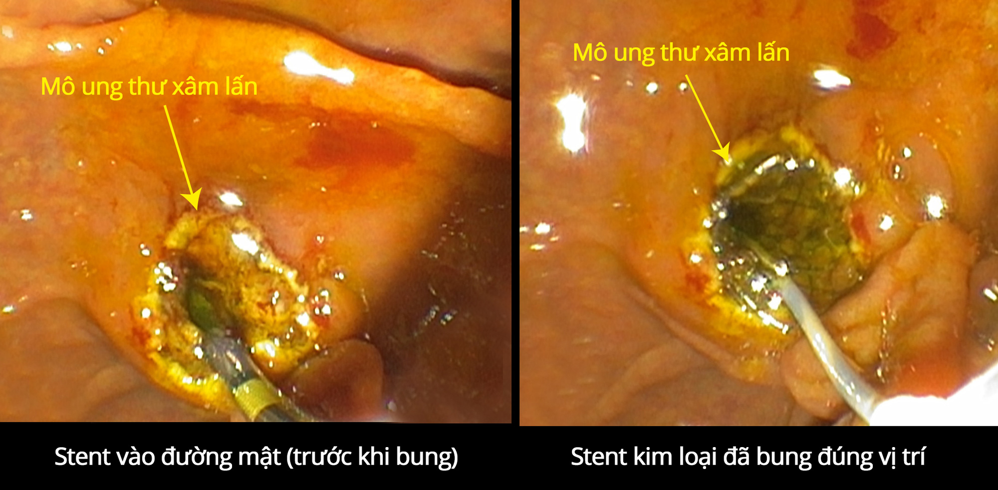 Phút giây giải tắc mật cho ca bệnh đã hôn mê