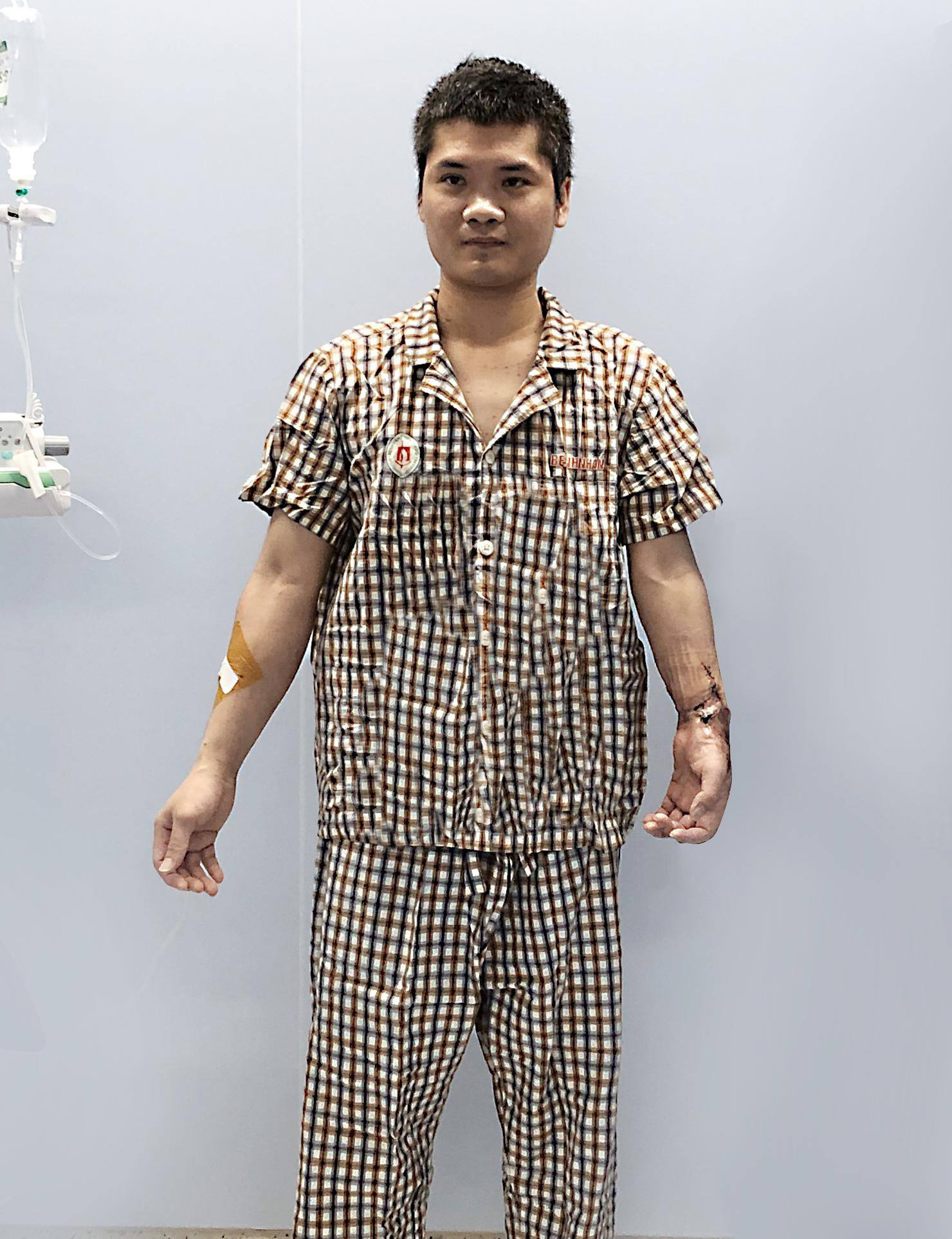 Việt Nam thực hiện th&agrave;nh c&ocirc;ng ca gh&eacute;p chi thể đầu ti&ecirc;n tr&ecirc;n thế giới từ người hiến sống - Ảnh 5.