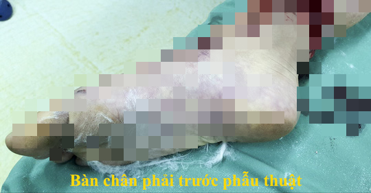 Căng thẳng cứu lấy bàn chân bệnh nhi bị dập gần nát do TNGT