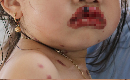 Bé gái 3 tuổi mắc chứng bệnh lạ khiến lở loét toàn bộ 2 môi