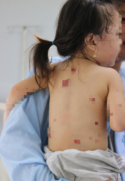 B&eacute; g&aacute;i 3 tuổi mắc chứng bệnh lạ khiến lở lo&eacute;t to&agrave;n bộ 2 m&ocirc;i - Ảnh 2.