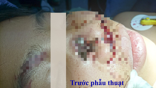 Hãi hùng khúc gỗ đâm xuyên thấu mũi bé trai 8 tuổi