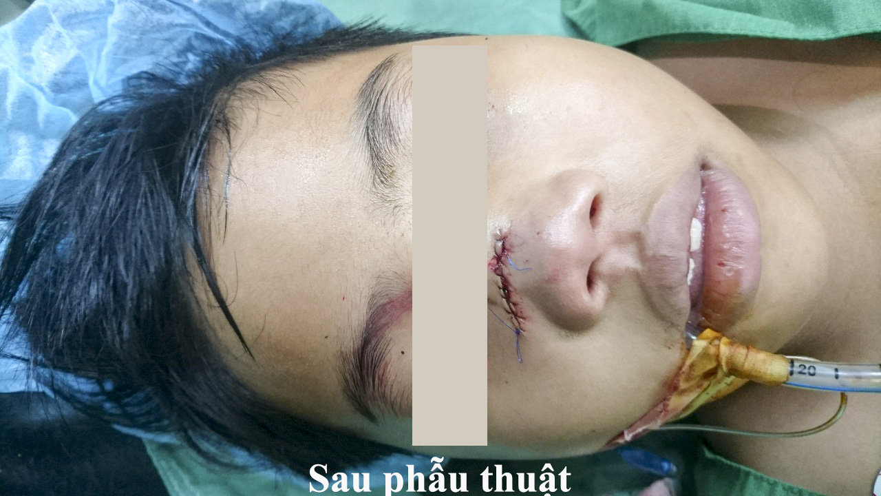 H&atilde;i h&ugrave;ng kh&uacute;c gỗ đ&acirc;m xuy&ecirc;n thấu mũi b&eacute; trai 8 tuổi - Ảnh 2.