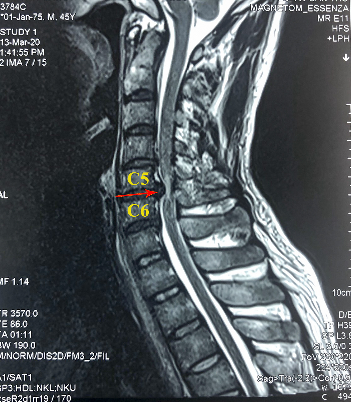 CLIP: Bệnh nh&acirc;n đầu ti&ecirc;n ở ĐBSCL được thay đĩa đệm nh&acirc;n tạo cột sống cổ - Ảnh 2.