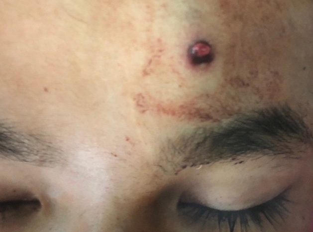 Thiếu niên 16 tuổi bị đạn bắn xuyên não khi đi săn cùng bạn