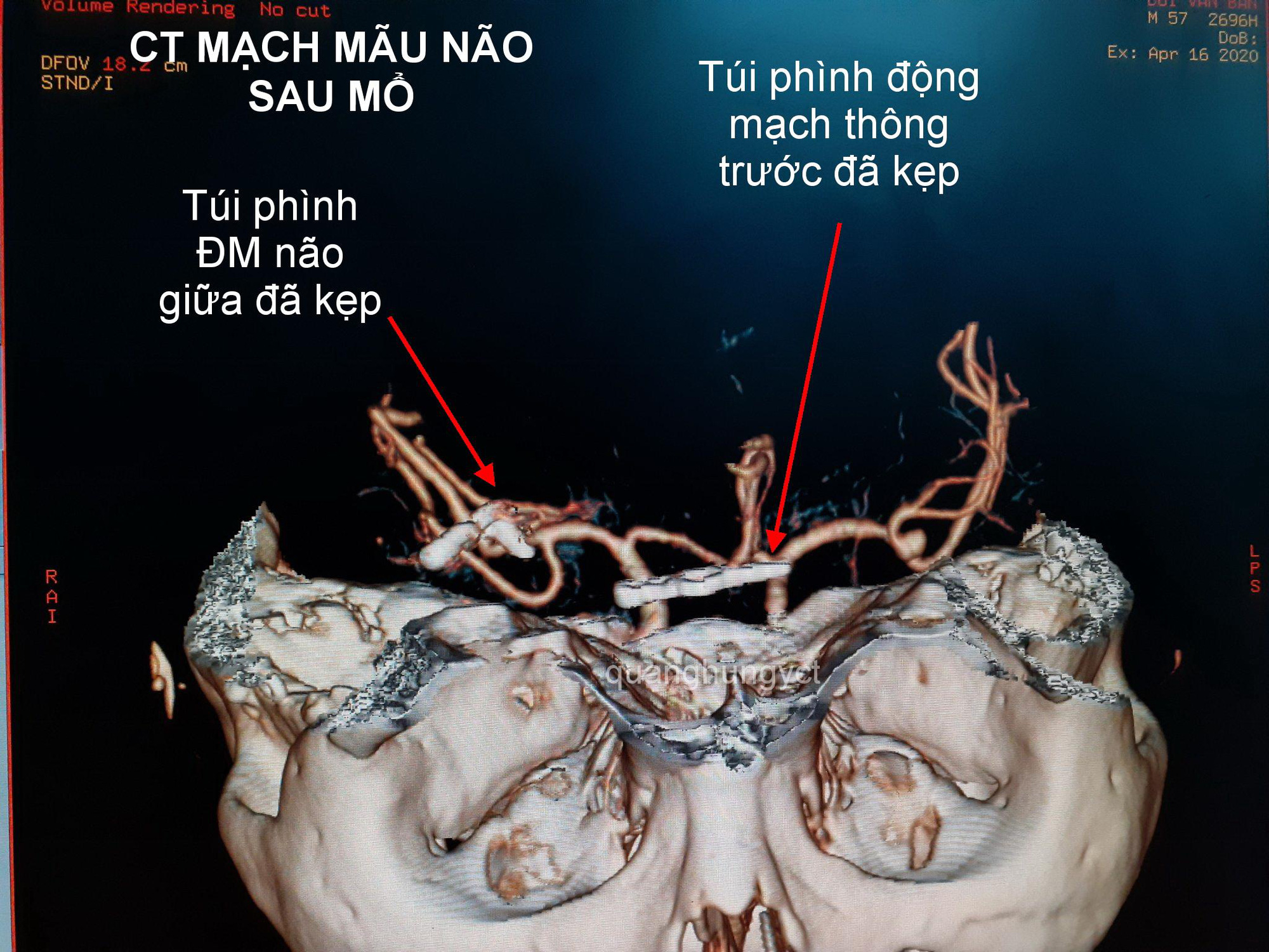4 giờ căng thẳng giành lấy sự sống cho bệnh nhân tưởng chừng như tử vong