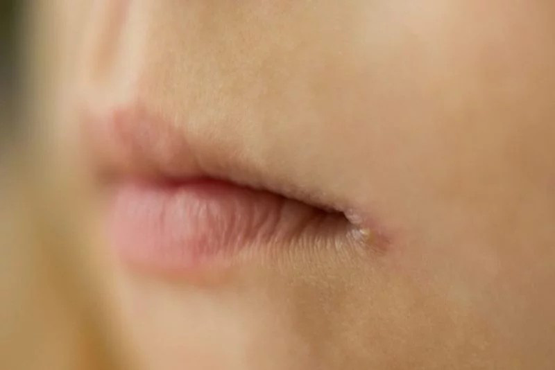 Nguy&ecirc;n nh&acirc;n v&agrave; c&aacute;ch đối ph&oacute; với m&ocirc;i kh&ocirc;, m&ocirc;i nứt nẻ - Ảnh 3.