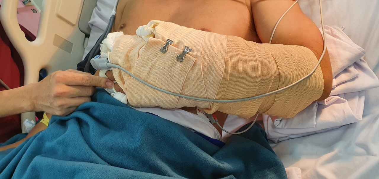 Vụ người đàn ông đi ô tô ở TP HCM bị chặt rớt tay: Nối thành công cẳng tay bị chém lìa