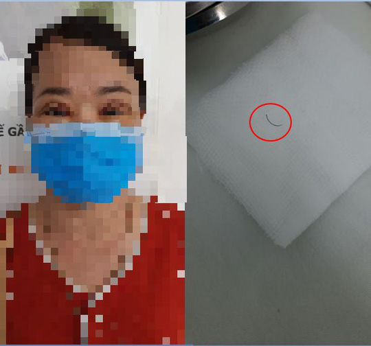 Bỏ qu&ecirc;n kim kh&acirc;u trong m&iacute; mắt, t&uacute;i ngực bị vỡ sau nhiều năm thẩm mỹ - Ảnh 1.