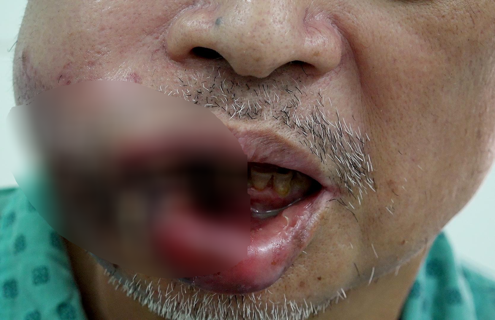 Ớn lạnh nhìn mụn nhọt tàn phá miệng một người đàn ông