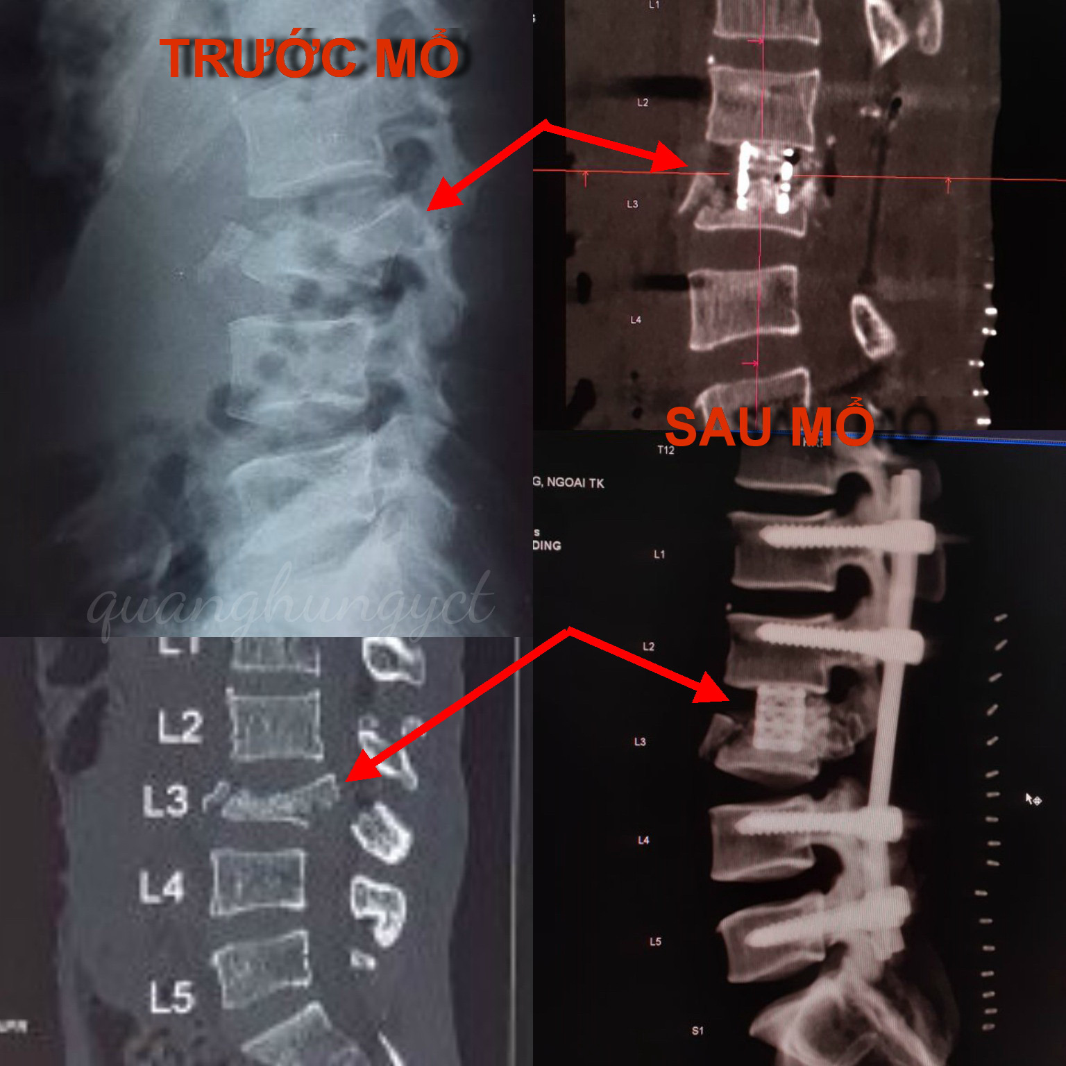 Cứu sống ngoạn mục thanh ni&ecirc;n ngh&egrave;o t&eacute; c&acirc;y dừa cao 5m khiến đốt sống g&atilde;y n&aacute;t - Ảnh 1.
