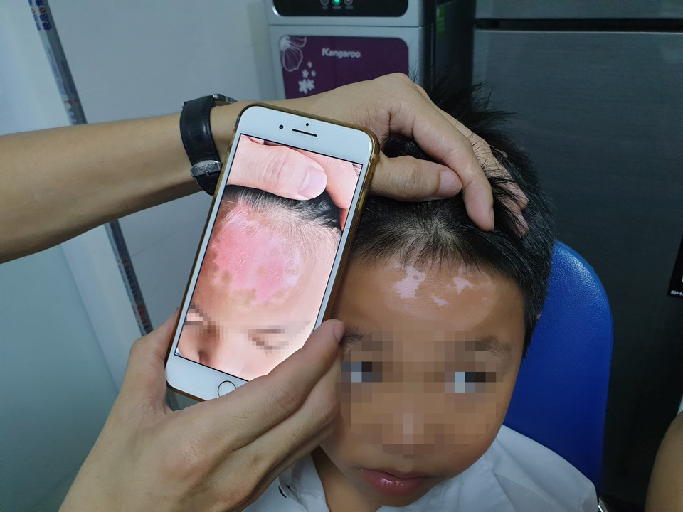 Tin vui cho người mắc bệnh bạch biến