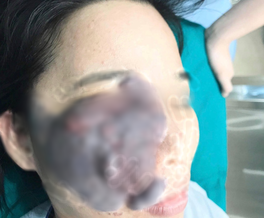 Nữ công nhân ở Bình Dương bị u máu ăn nửa mặt được phẫu thuật miễn phí - Ảnh 1.