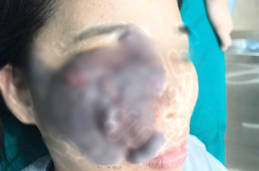 Nữ công nhân ở Bình Dương bị u máu "ăn" nửa mặt được phẫu thuật miễn phí