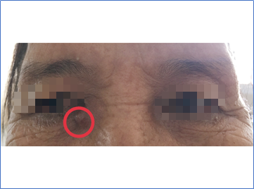 Bác sĩ đưa ra cảnh báo khi thấy khối u thịt nhỏ dưới vùng mắt