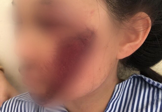 Áo chống nắng cuốn vào bánh xe khiến nữ sinh tổn thương mặt nghiêm trọng