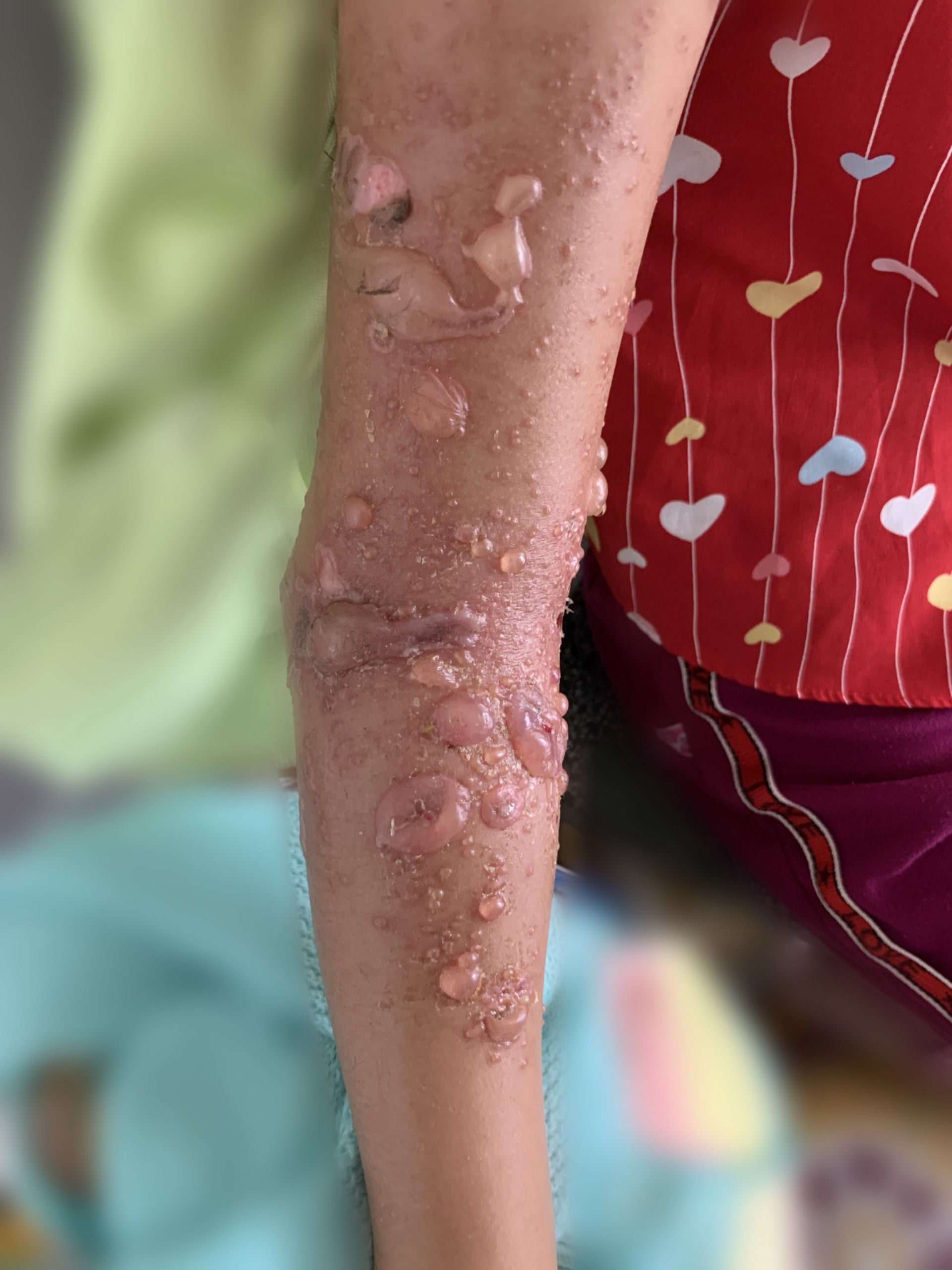 Bất ngờ l&agrave;n da phỏng rộp sau khi tắm biển - Ảnh 1.