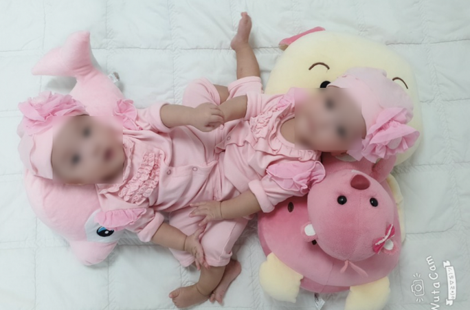 Hôm nay, gần 100 chuyên gia mổ tách song sinh dính nhau