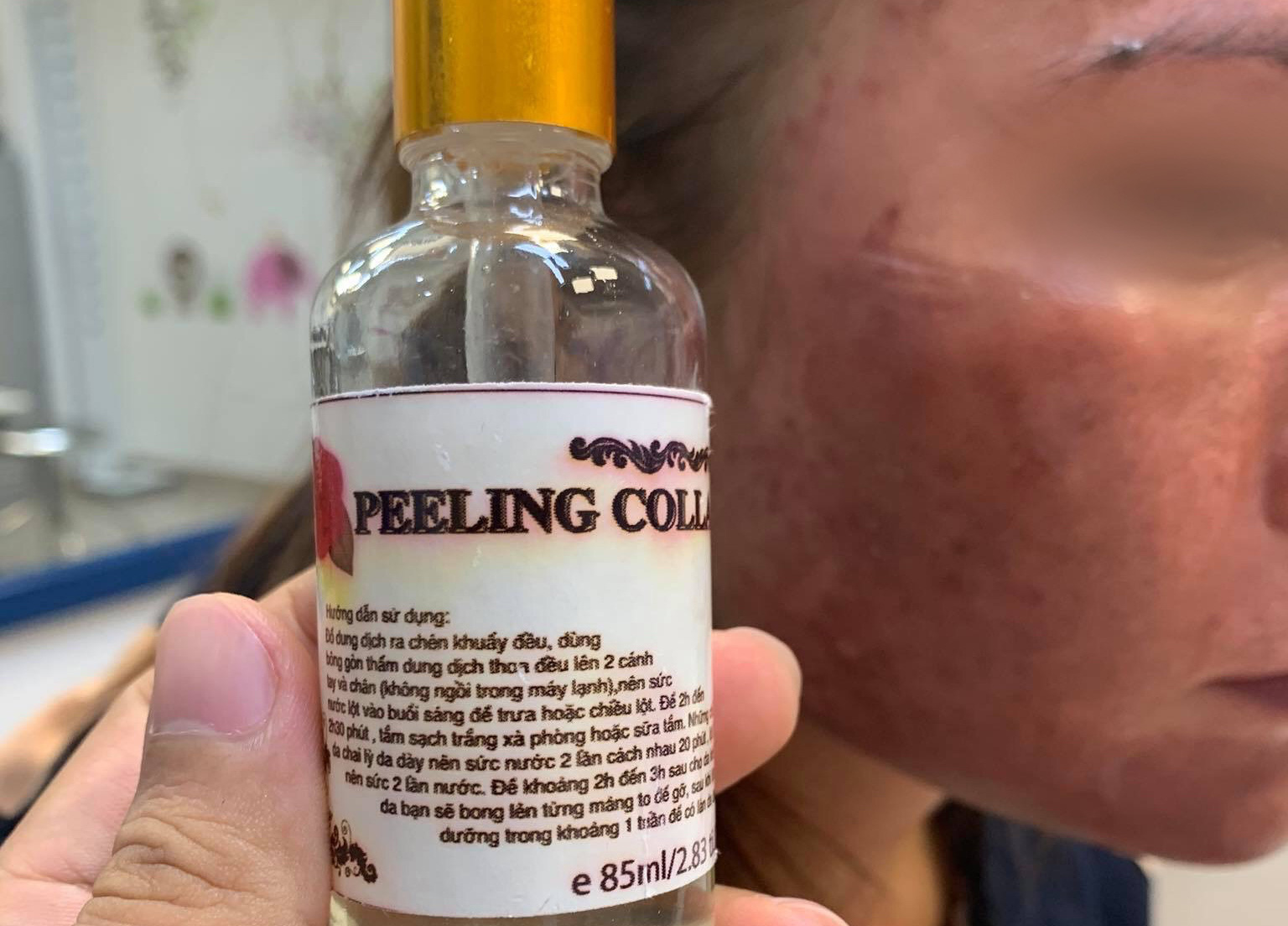 Trị nám bằng dưỡng chất mua trên mạng, da mặt cô gái trẻ đen sạm