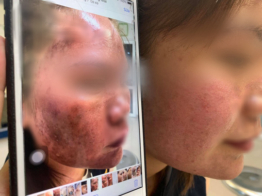 Trị n&aacute;m bằng dưỡng chất mua tr&ecirc;n mạng, da mặt c&ocirc; g&aacute;i trẻ đen sạm - Ảnh 2.