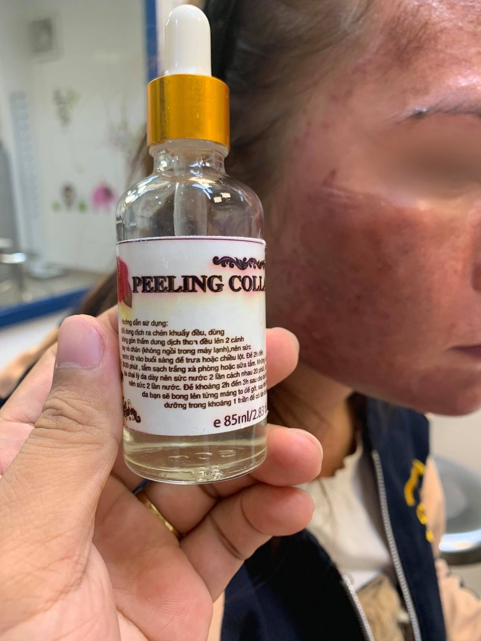 Trị n&aacute;m bằng dưỡng chất mua tr&ecirc;n mạng, da mặt c&ocirc; g&aacute;i trẻ đen sạm - Ảnh 1.