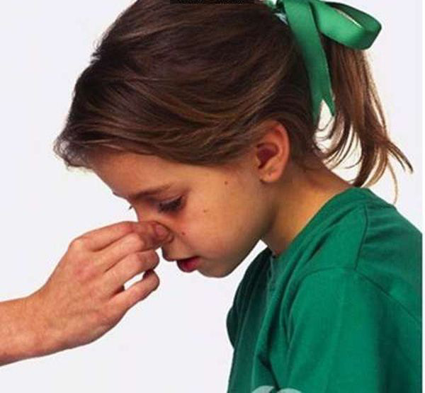 Chảy máu cam mà ngửa đầu ra sẽ viêm phổi?