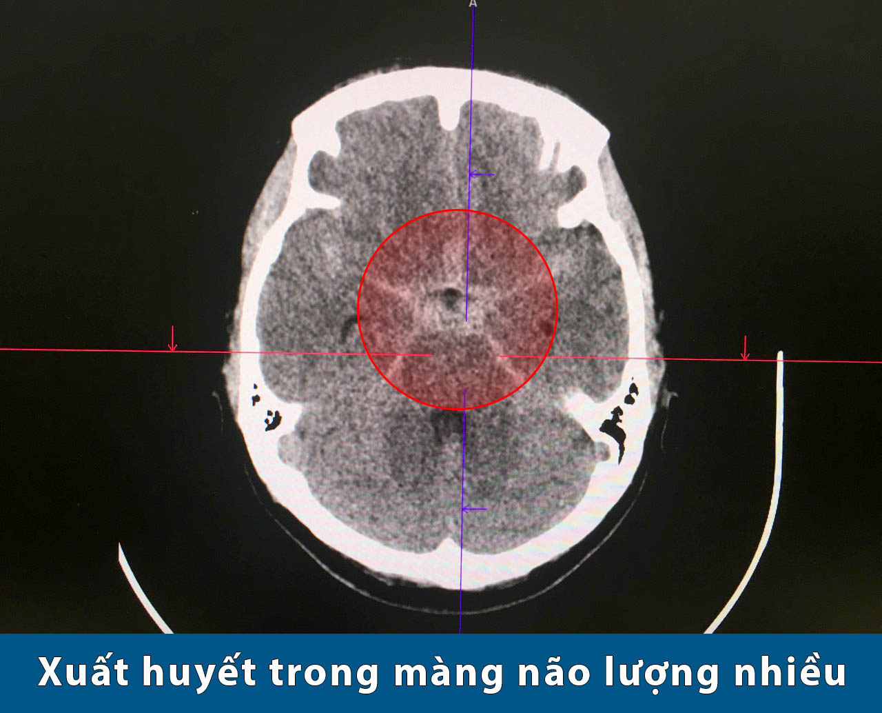 Nút túi phình mạch máu não, cứu cô gái 5 lần đột quỵ