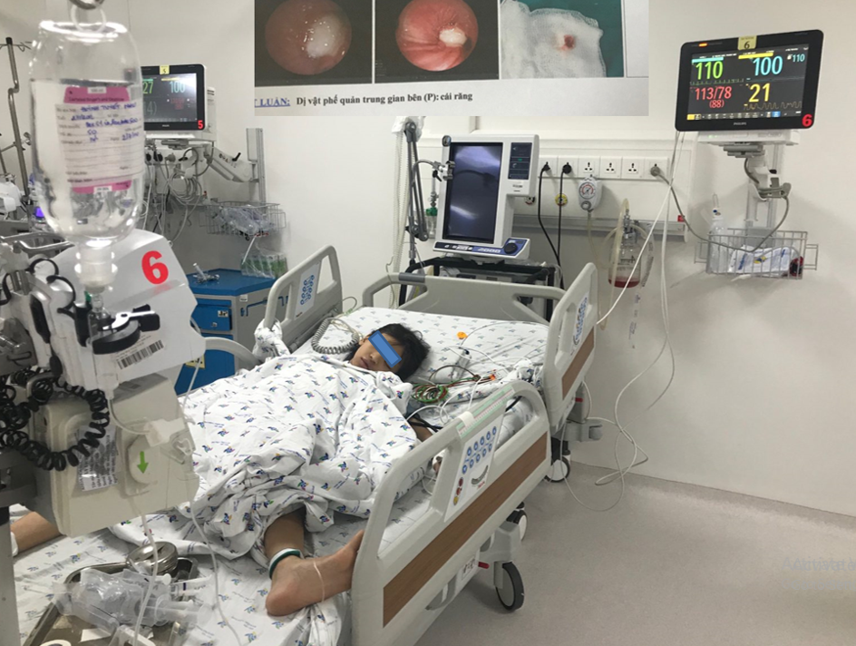 Nhổ răng sâu, răng văng luôn vào đường thở khiến bé gái phải nhập viện